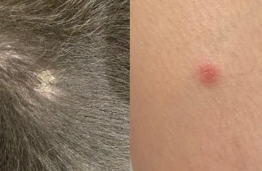 人得貓癬多久會好？獸醫與過來人教你加速復原的關鍵