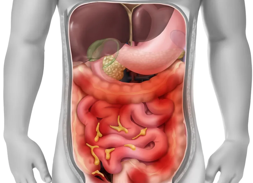 腹膜炎原因 腹膜炎原因